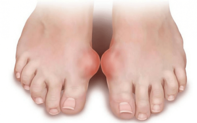 Deformidade do pé como causa da aparición de fungos nas pernas