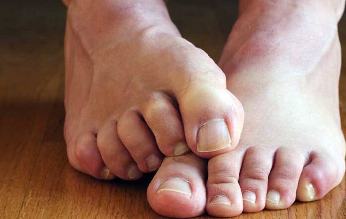 Síntomas do epitelio escamoso nos pés