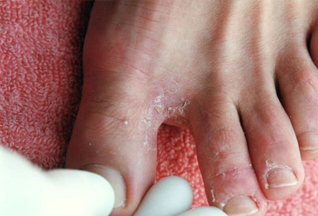 Síntomas dun fungo entre os dedos dos pés