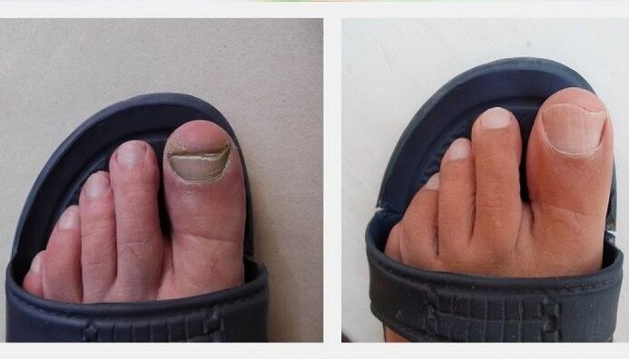 Unhas dos pés antes e despois de tratar o fungo con vinagre de mazá