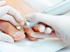 Pedicura terapéutica contra o fungo das unhas dos pés