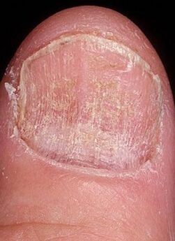 Mycosis do cravo
