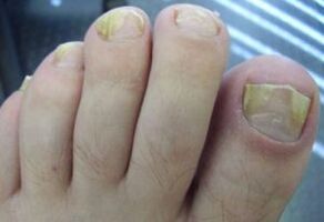 Afectado pola uña con infeccións por fungos