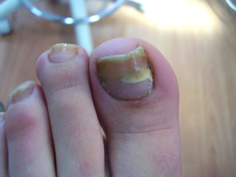 Como tratar as uñas amarelas por fungo con gotas