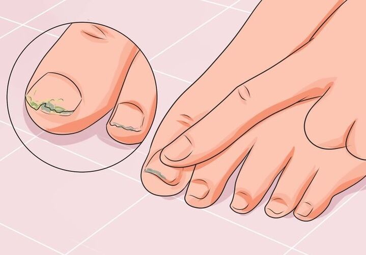 Como tratar o fungo das unhas dos pés con gotas