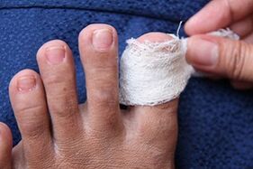 Comprimir contra fungos nas unhas